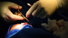 Rhinoplasty In The Cleft Lip & Palate Patient